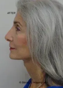 Deep Plane Facelift after at The Center for Cosmetic Surgery and The Washington Hair Institute with Dr. Steven B. Hopping in Washington, DC