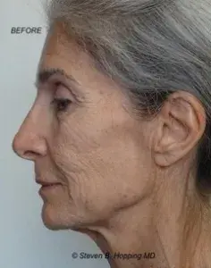 Deep Plane Facelift before at The Center for Cosmetic Surgery and The Washington Hair Institute with Dr. Steven B. Hopping in Washington, DC