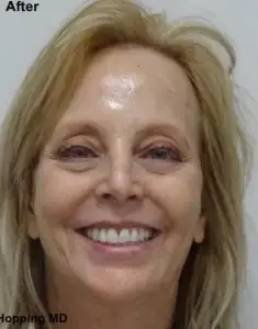 Deep Plane Facelift after at The Center for Cosmetic Surgery and The Washington Hair Institute with Dr. Steven B. Hopping in Washington, DC
