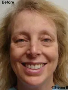 Deep Plane Facelift before at The Center for Cosmetic Surgery and The Washington Hair Institute with Dr. Steven B. Hopping in Washington, DC