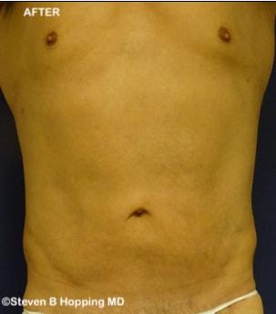 The Center for Cosmetic Surgery and The Washington Hair Institute with Dr. Steven B. Hopping liposuction after — Washington, DC