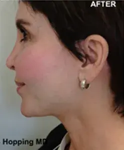 Deep Plane Facelift after at The Center for Cosmetic Surgery and The Washington Hair Institute with Dr. Steven B. Hopping in Washington, DC