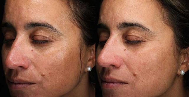 Chemical Peel result at Brickell Cosmetic Center in Miami, FL