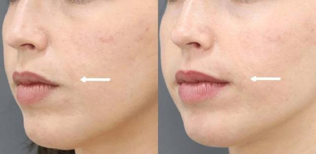 Juvederm result at Brickell Cosmetic Center in Miami, FL