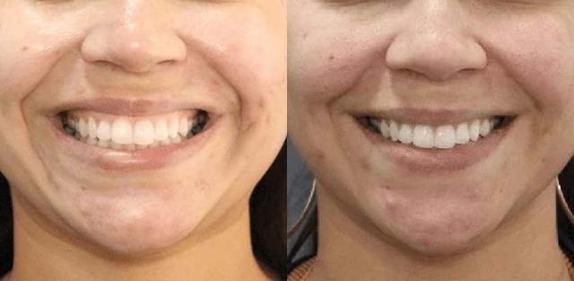 Botox result at Brickell Cosmetic Center in Miami, FL