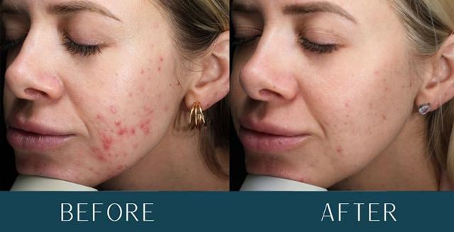 Chemical Peel result at Brickell Cosmetic Center in Miami, FL