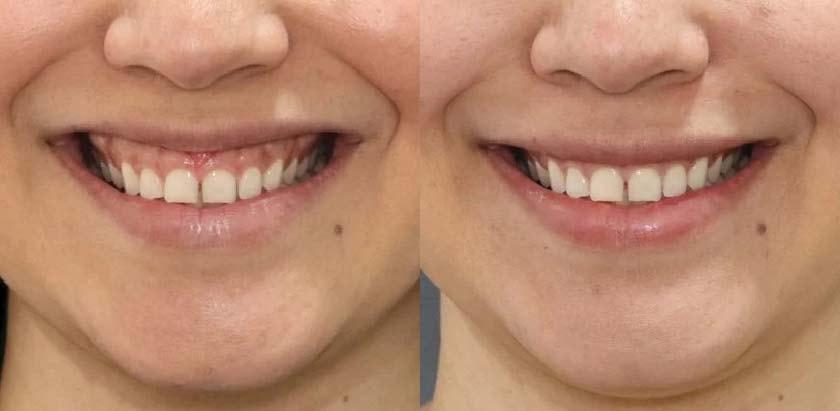 Brickell Cosmetic Center botox result — Miami, FL