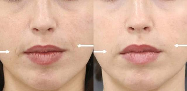 Juvederm result at Brickell Cosmetic Center in Miami, FL