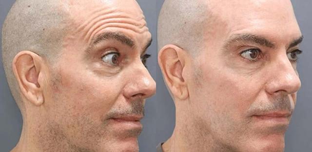 Botox result at Brickell Cosmetic Center in Miami, FL