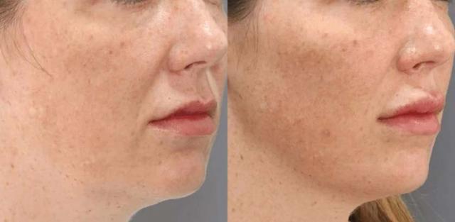 Jawline Filler result at Brickell Cosmetic Center in Miami, FL