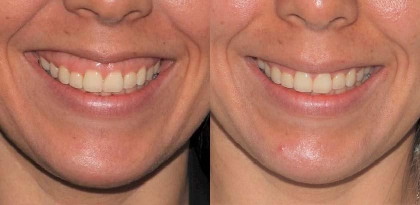 Brickell Cosmetic Center botox result — Miami, FL