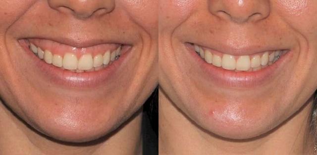 Botox result at Brickell Cosmetic Center in Miami, FL