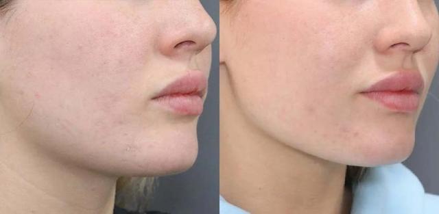Jawline Filler result at Brickell Cosmetic Center in Miami, FL