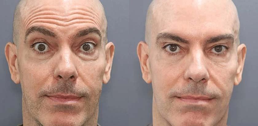 Brickell Cosmetic Center botox result — Miami, FL