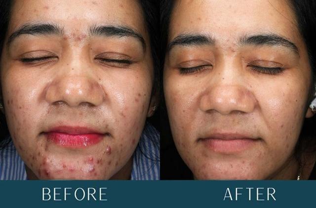 Chemical Peel result at Brickell Cosmetic Center in Miami, FL