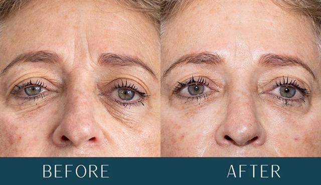 Juvederm result at Brickell Cosmetic Center in Miami, FL