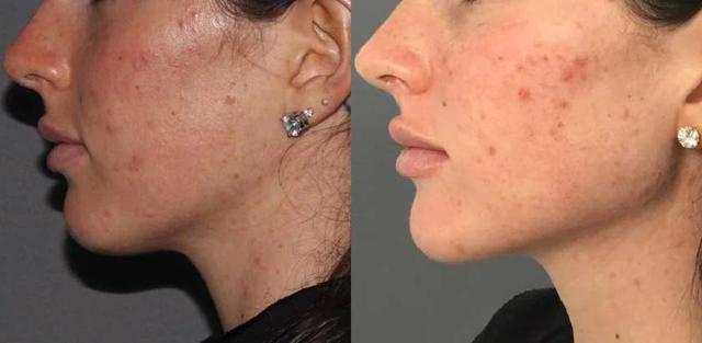 Jawline Filler result at Brickell Cosmetic Center in Miami, FL