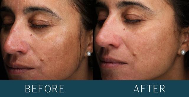 Chemical Peel result at Brickell Cosmetic Center in Miami, FL