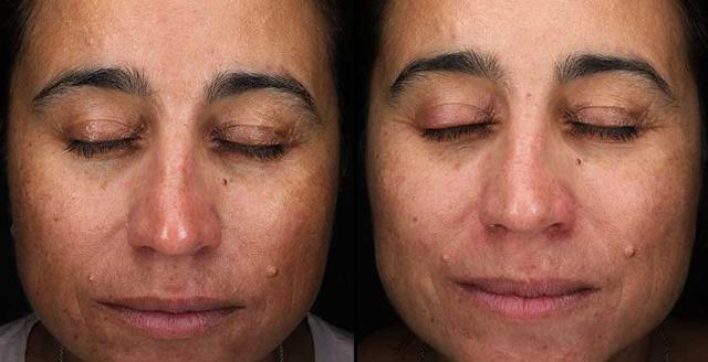 Chemical Peel result at Brickell Cosmetic Center in Miami, FL
