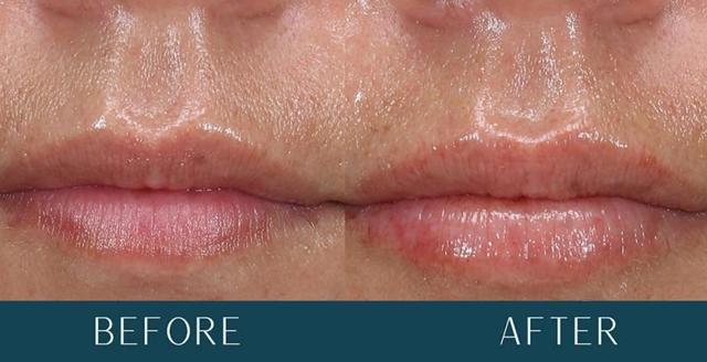 Lip Filler result at Brickell Cosmetic Center in Miami, FL