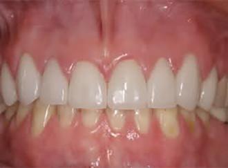 Perfect Smiles Plano Family Dentistry dental crowns after — Plano, TX