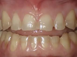 Dental Crowns before at Perfect Smiles Plano Family Dentistry in Plano, TX