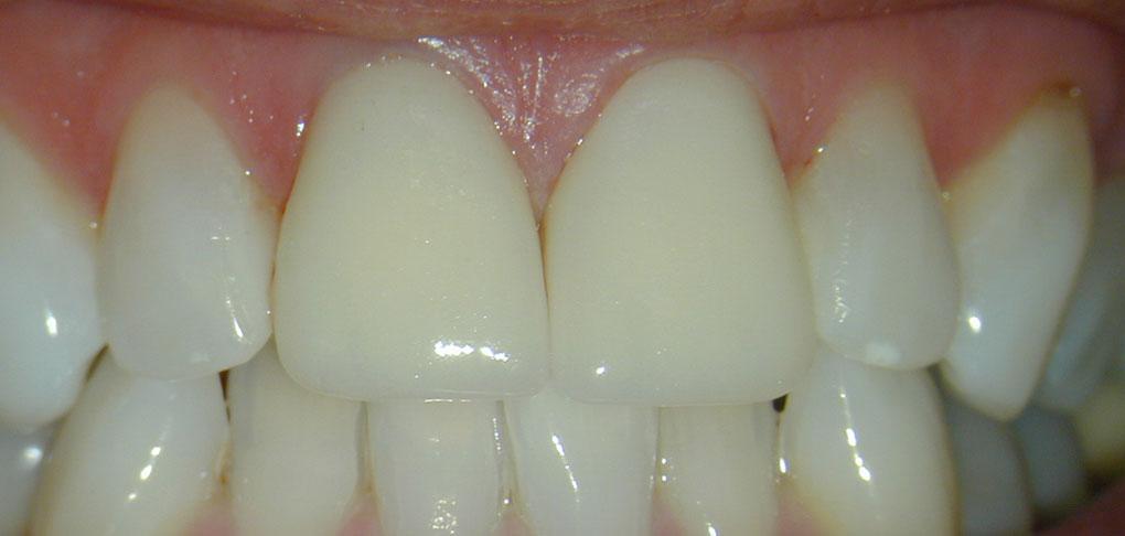 Perfect Smiles Plano Family Dentistry veneers after — Plano, TX