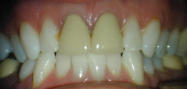 Dental Implants before at Perfect Smiles Plano Family Dentistry in Plano, TX