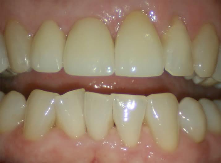 Perfect Smiles Plano Family Dentistry dental crowns after — Plano, TX