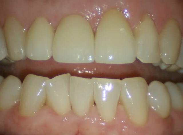 Dental Crowns after at Perfect Smiles Plano Family Dentistry in Plano, TX