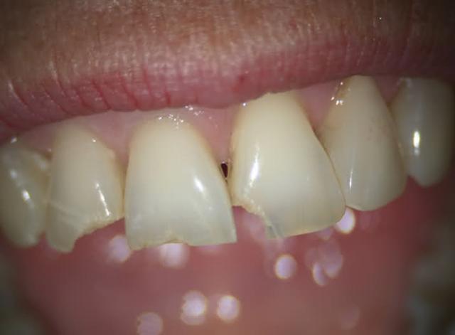 Dental Crowns before at Perfect Smiles Plano Family Dentistry in Plano, TX