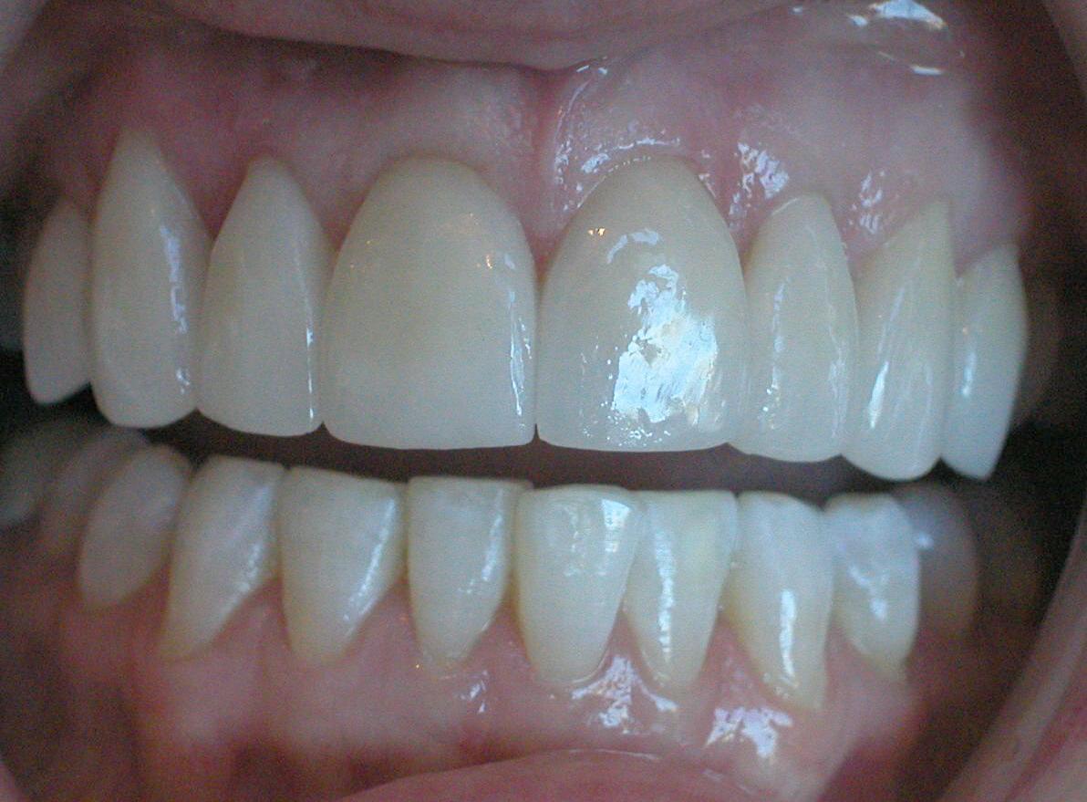 Perfect Smiles Plano Family Dentistry smile makeover after — Plano, TX
