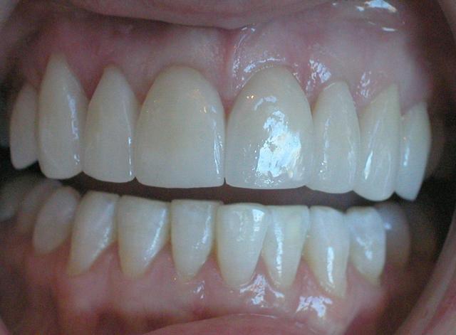 Smile Makeover after at Perfect Smiles Plano Family Dentistry in Plano, TX