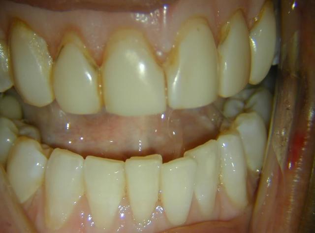 Smile Makeover before at Perfect Smiles Plano Family Dentistry in Plano, TX