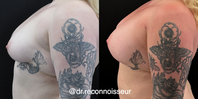 Breast Augmentation result at La Vie Plastic Surgery in Lone Tree, CO