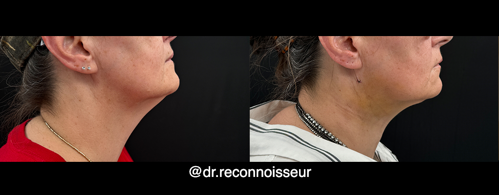 La Vie Plastic Surgery liposuction result — Lone Tree, CO