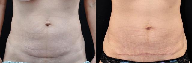 Tummy Tuck result at La Vie Plastic Surgery in Lone Tree, CO