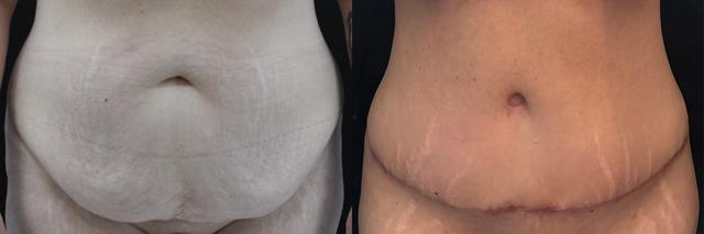 Tummy Tuck result at La Vie Plastic Surgery in Lone Tree, CO
