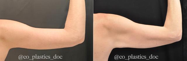 Arm Lift result at La Vie Plastic Surgery in Lone Tree, CO