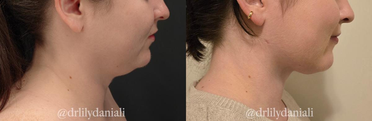 La Vie Plastic Surgery liposuction result — Lone Tree, CO