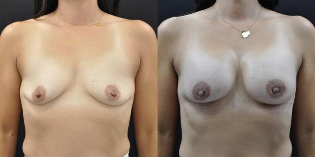 Breast Augmentation result at La Vie Plastic Surgery in Lone Tree, CO