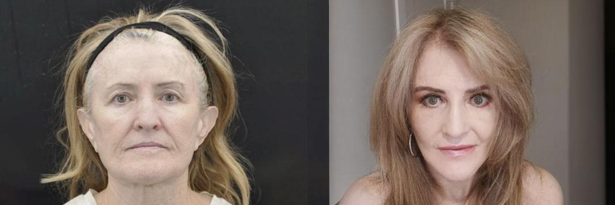 La Vie Plastic Surgery facelift result — Lone Tree, CO