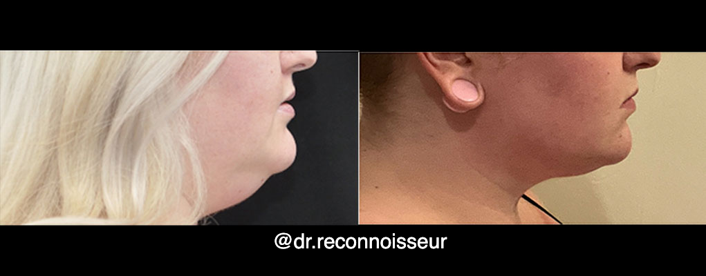 La Vie Plastic Surgery liposuction result — Lone Tree, CO
