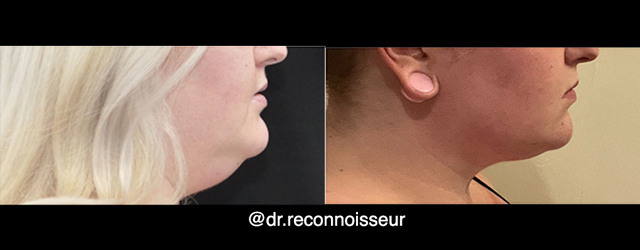 Liposuction result at La Vie Plastic Surgery in Lone Tree, CO