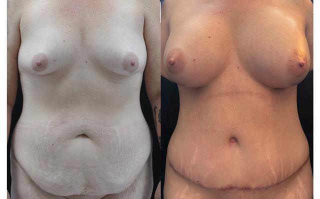 Mommy Makeover result at La Vie Plastic Surgery in Lone Tree, CO