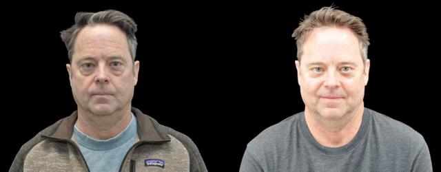 Blepharoplasty result at La Vie Plastic Surgery in Lone Tree, CO