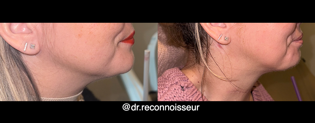 La Vie Plastic Surgery liposuction result — Lone Tree, CO