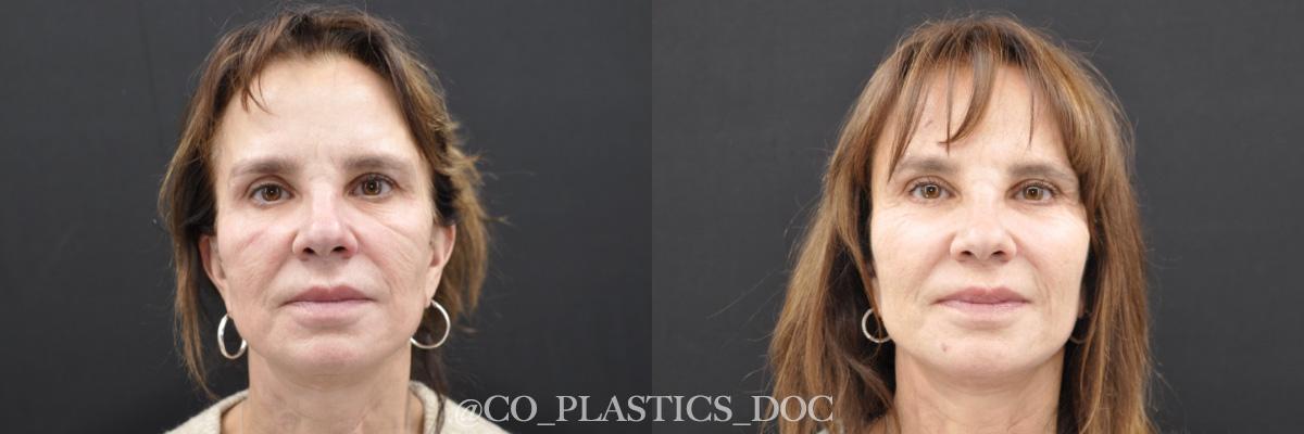 La Vie Plastic Surgery facelift result — Lone Tree, CO