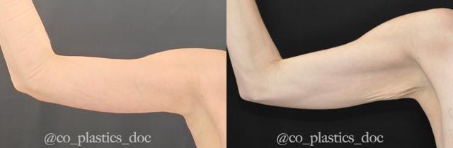 Arm Lift result at La Vie Plastic Surgery in Lone Tree, CO