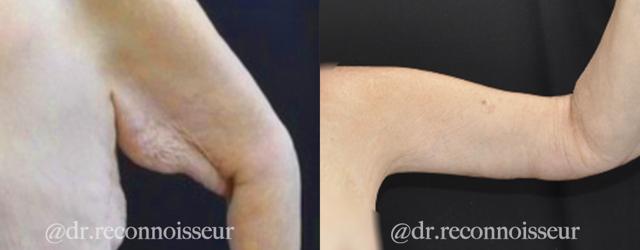 Arm Lift result at La Vie Plastic Surgery in Lone Tree, CO